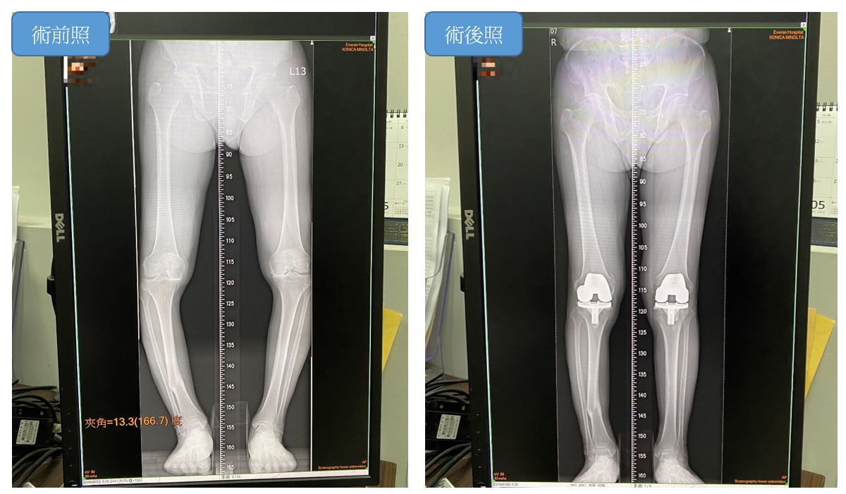 雙膝人工關節置換20220511-2